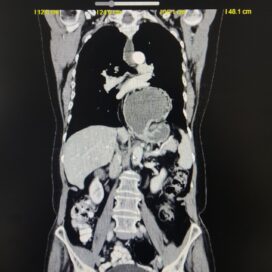 Correccion hernia hiatal