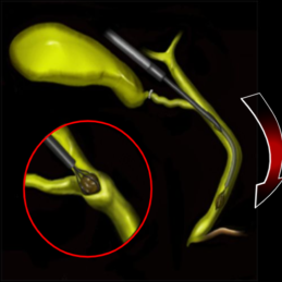 Exploración de vías biliares